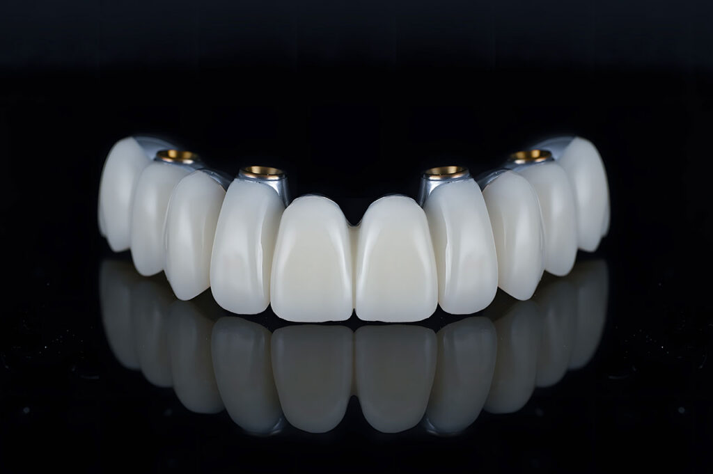 Sapphire Periodontics & Implant Dentistry | A Fixed Full-Arch Smile: Understanding All-on-4 Restoration
