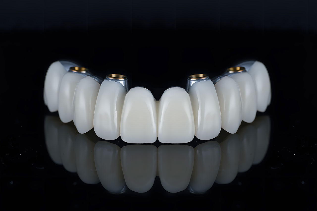 Sapphire Periodontics & Implant Dentistry | A Fixed Full-Arch Smile: Understanding All-on-4 Restoration Sapphire Periodontics & Implant Dentistry | A Fixed Full-Arch Smile: Understanding All-on-4 Restoration