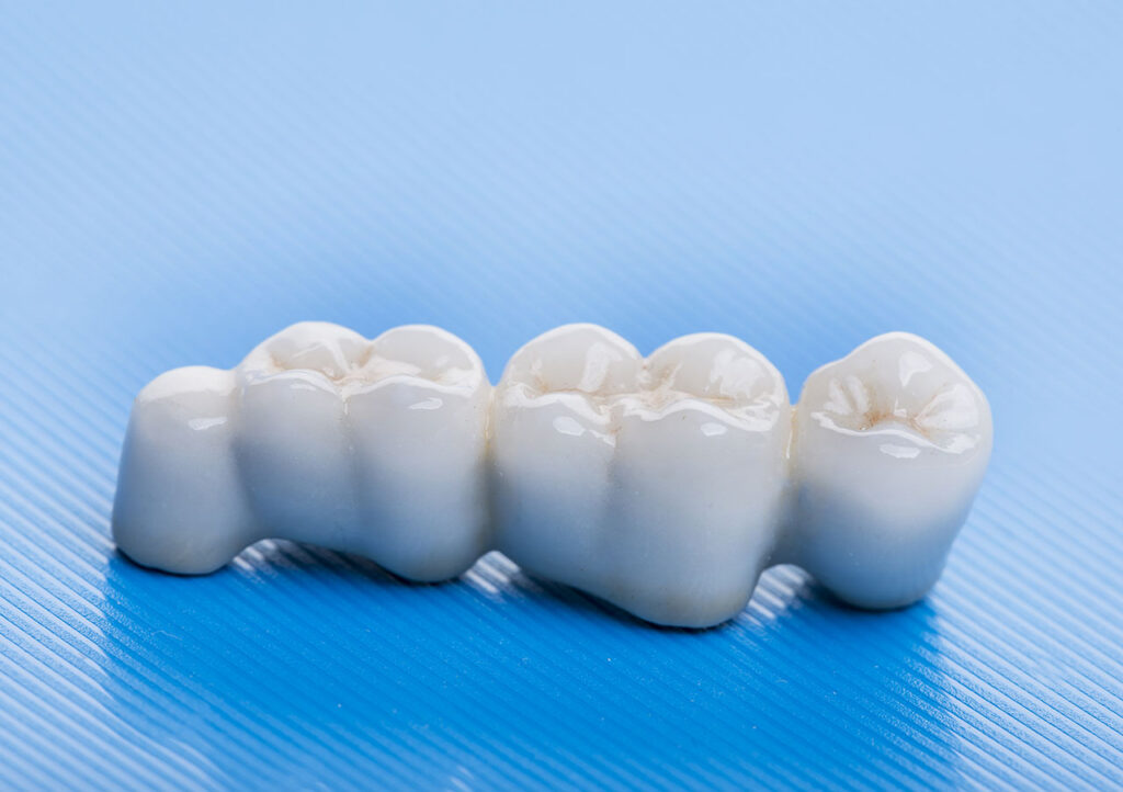 Sapphire Periodontics & Implant Dentistry | Bridging the Gap With Strength: A Simple Guide to Implant Bridges