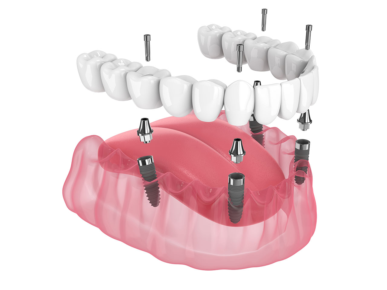 Sapphire Periodontics & Implant Dentistry | All-on-4 Implants: A Fixed Full-Arch Option for a More Secure Smile