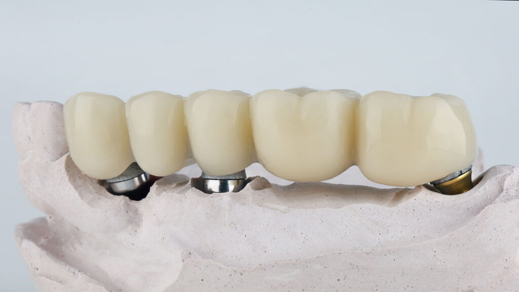 Sapphire Periodontics & Implant Dentistry | Implant Bridges for Multiple Missing Teeth: A Stronger Way to Rebuild Your Smile