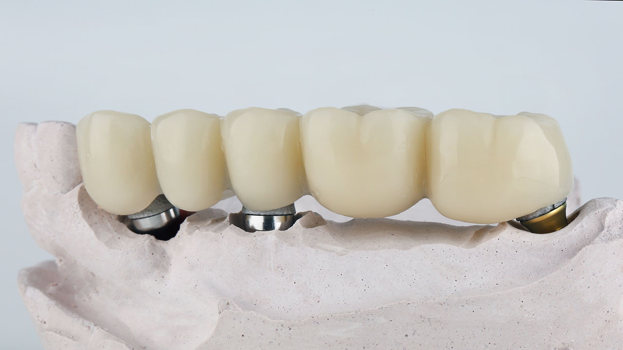 Sapphire Periodontics & Implant Dentistry | Implant Bridges for Multiple Missing Teeth: A Stronger Way to Rebuild Your Smile